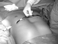 Деформация грудной клетки у детей и подростков - виды, диагностика, лечение, операция